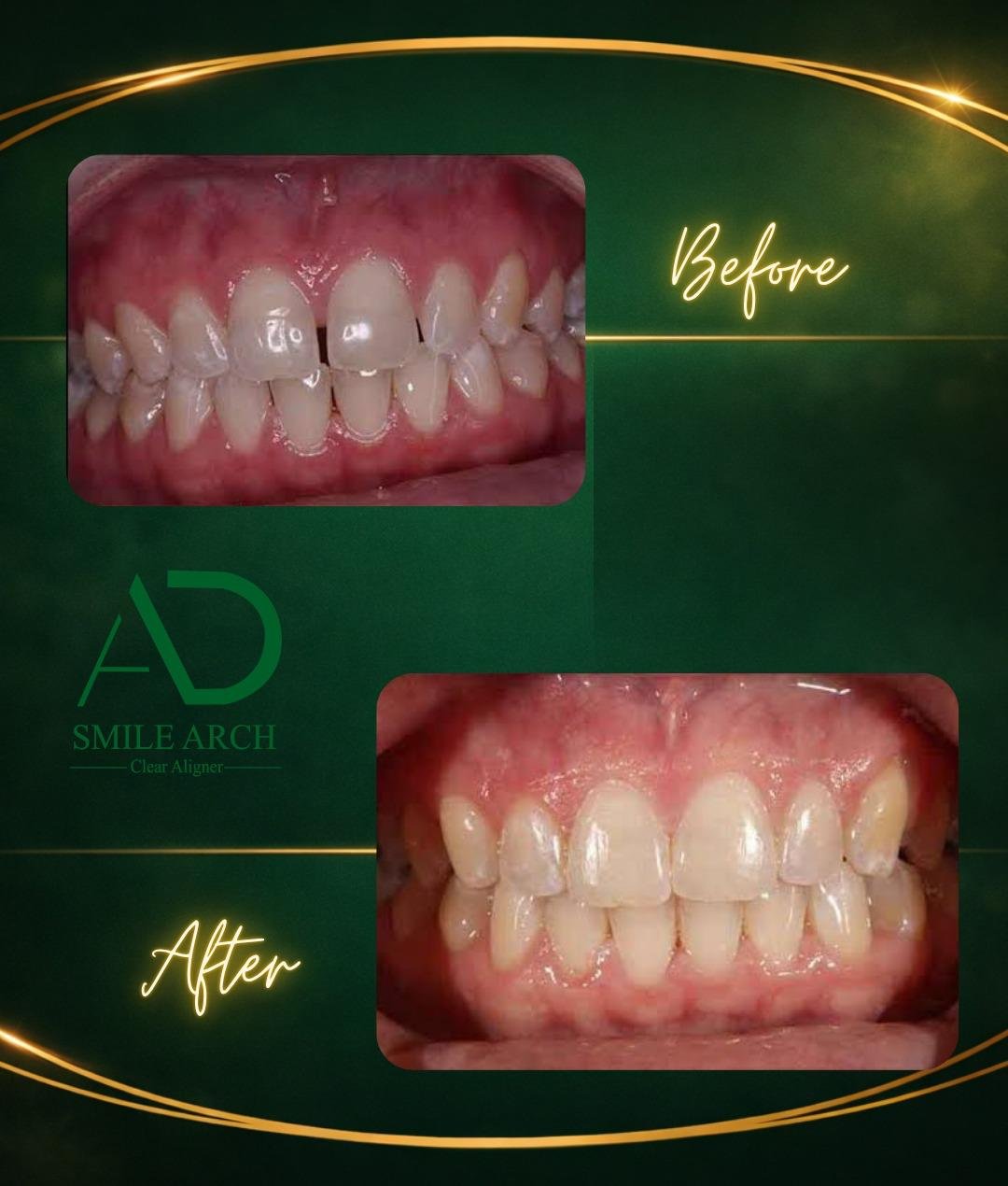 Smile transformation: bite correction