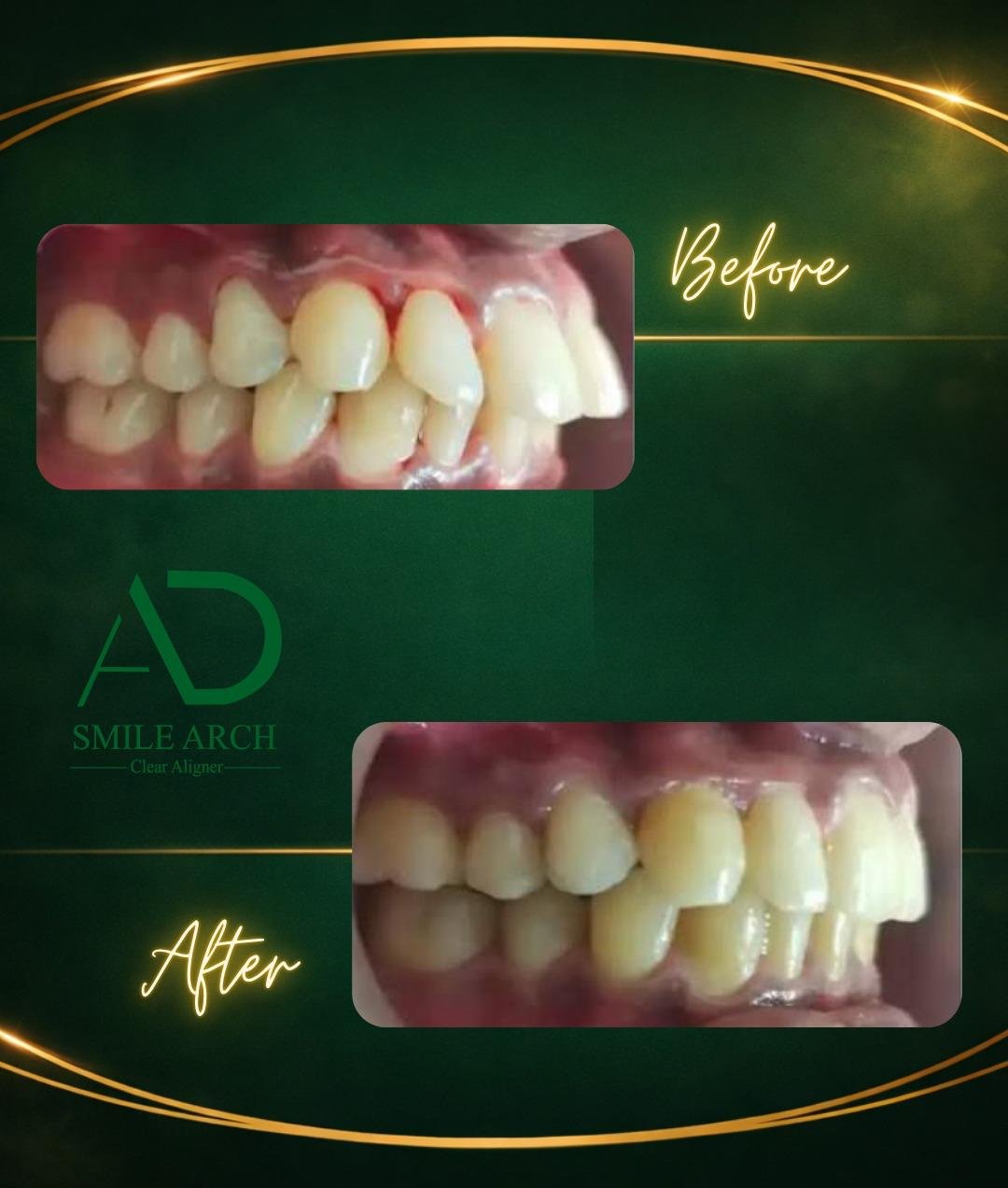 Smile transformation: crowding correction